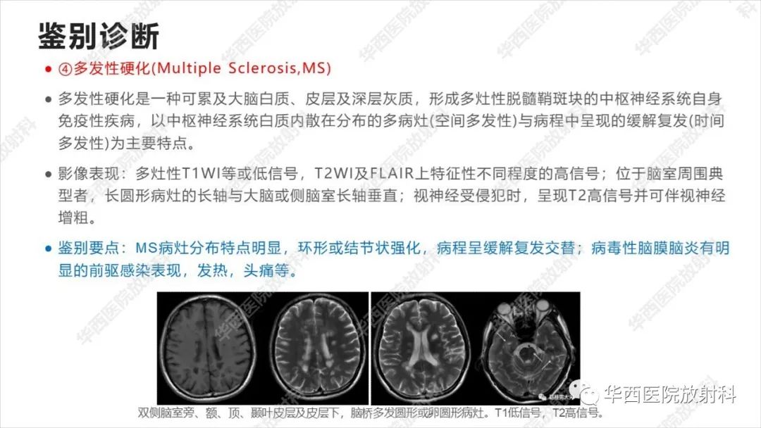 【病例】出血坏死性病毒脑膜脑炎1例CT及MR影像学表现和鉴别诊断-25