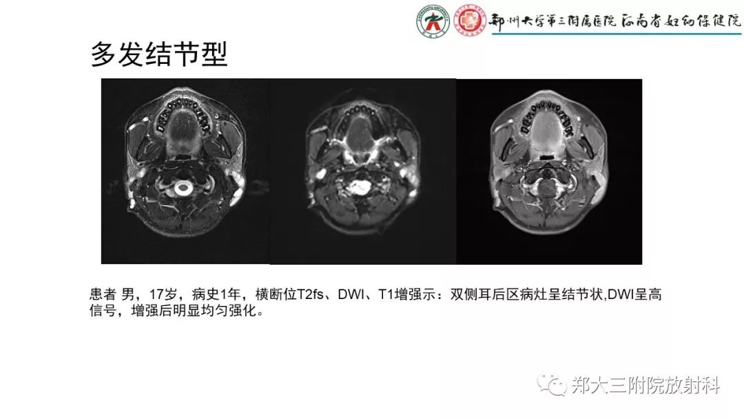 【PPT】木村病(kimura disease)临床特征及MR表现-7