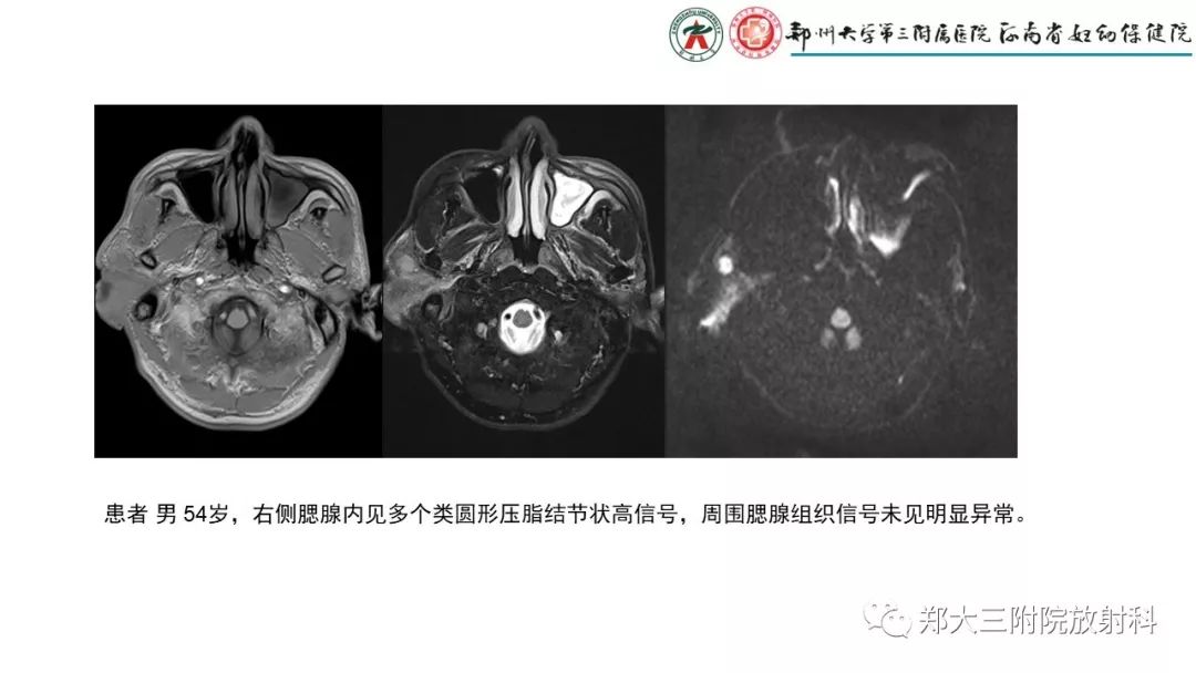 【PPT】木村病(kimura disease)临床特征及MR表现-8