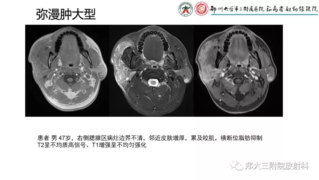 【PPT】木村病(kimura disease)临床特征及MR表现-9