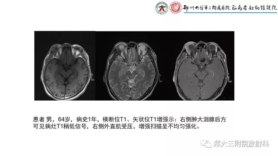 【PPT】木村病(kimura disease)临床特征及MR表现-12