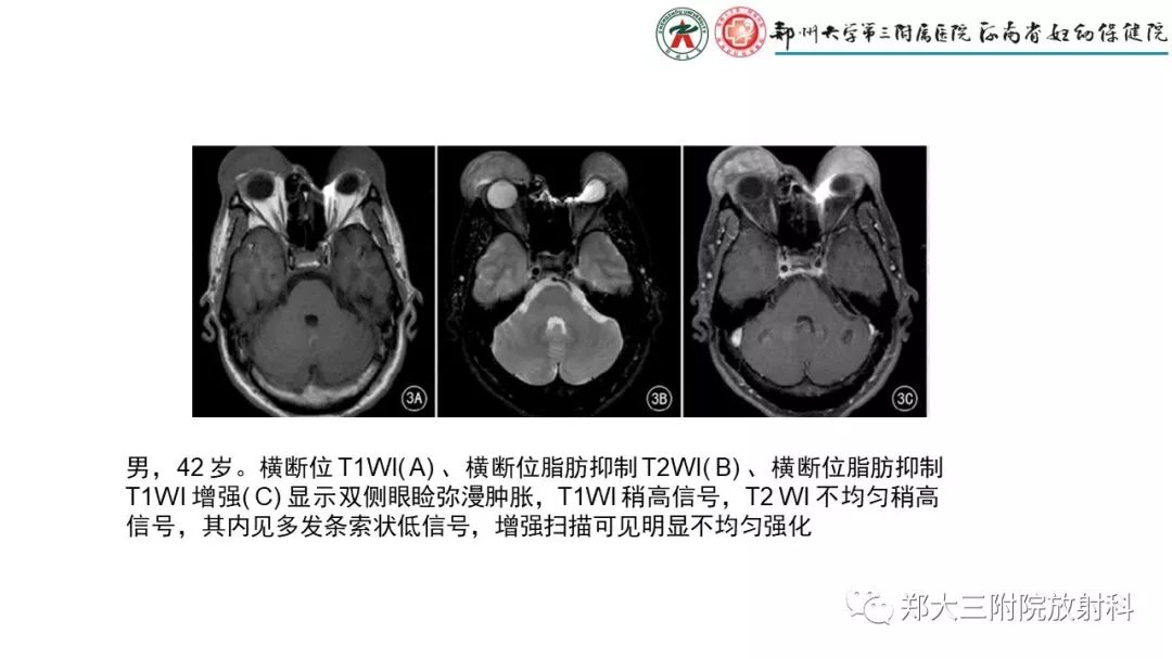 【PPT】木村病(kimura disease)临床特征及MR表现-13