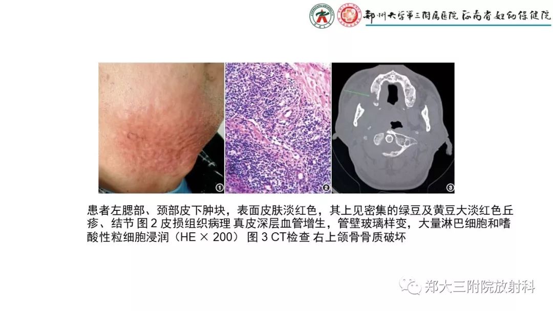 【PPT】木村病(kimura disease)临床特征及MR表现-14