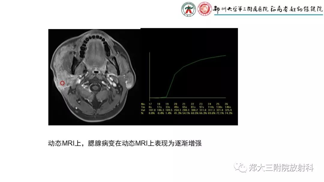 【PPT】木村病(kimura disease)临床特征及MR表现-10