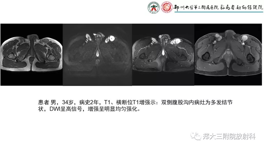 【PPT】木村病(kimura disease)临床特征及MR表现-16