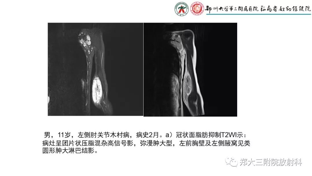 【PPT】木村病(kimura disease)临床特征及MR表现-17