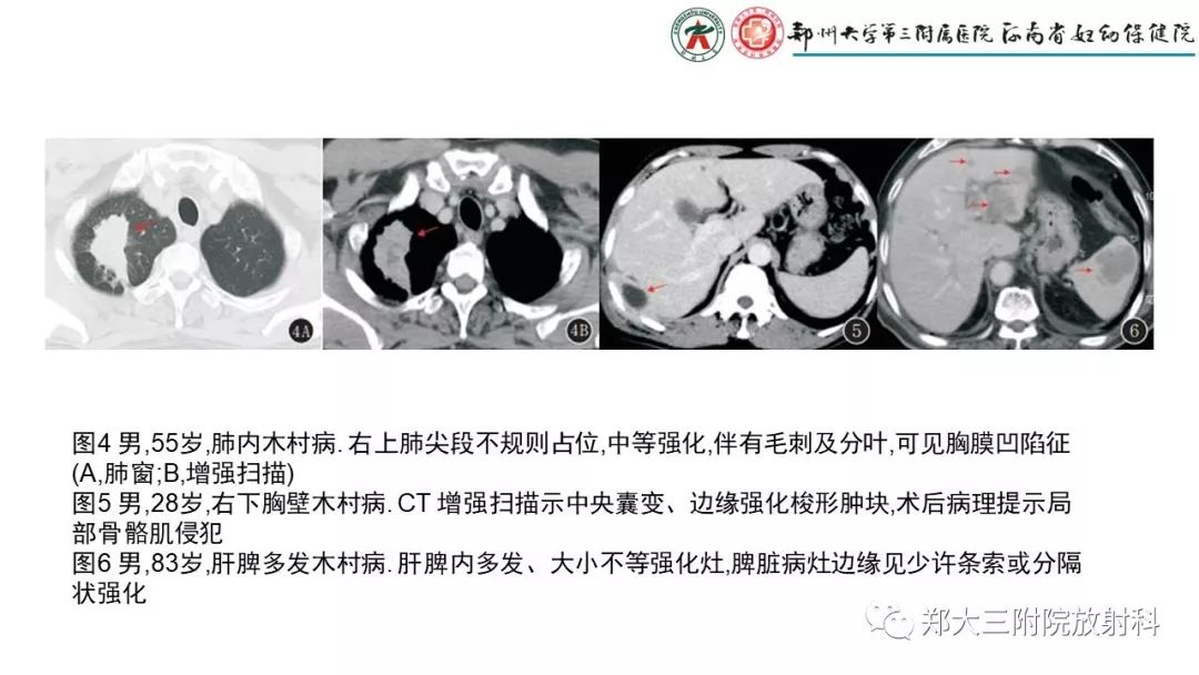 【PPT】木村病(kimura disease)临床特征及MR表现-18