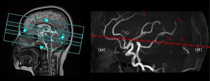 颅内3D TOF-MRA成像中的几个技术要点-1