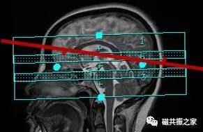 颅内3D TOF-MRA成像中的几个技术要点-2