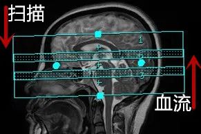 颅内3D TOF-MRA成像中的几个技术要点-3