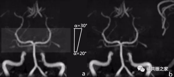 颅内3D TOF-MRA成像中的几个技术要点-5