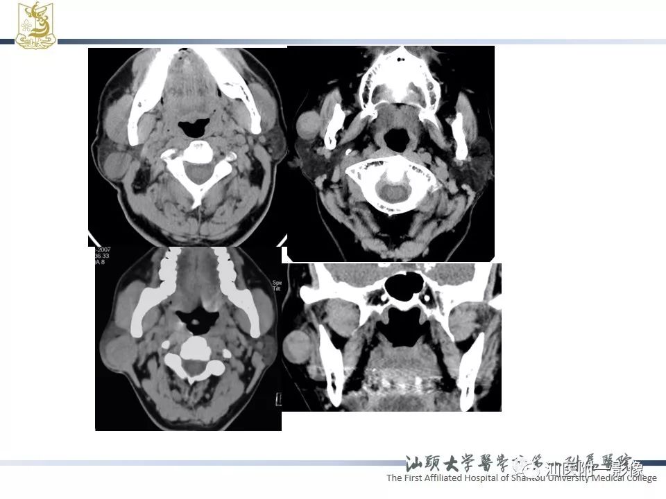 【PPT】腮腺病变CT诊断-5