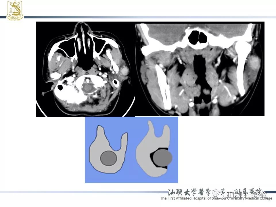 【PPT】腮腺病变CT诊断-6
