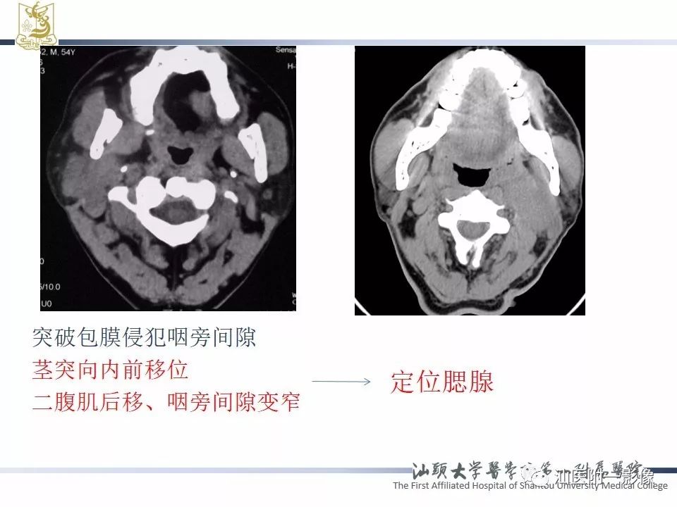 【PPT】腮腺病变CT诊断-7