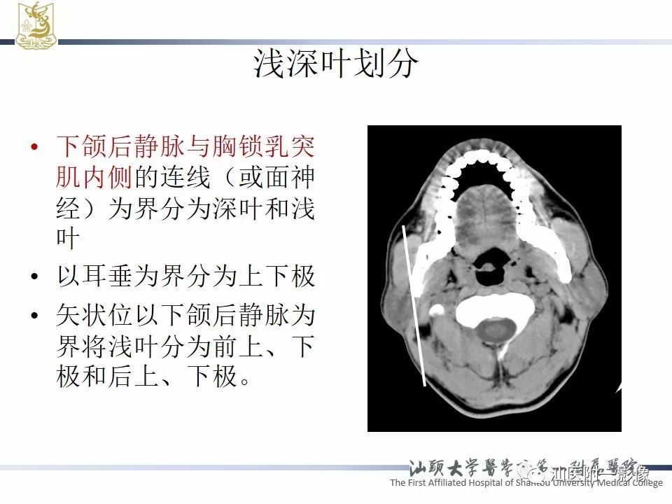【PPT】腮腺病变CT诊断-8