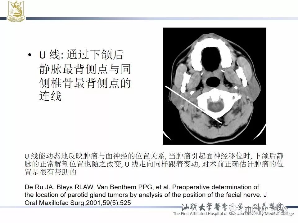 【PPT】腮腺病变CT诊断-9