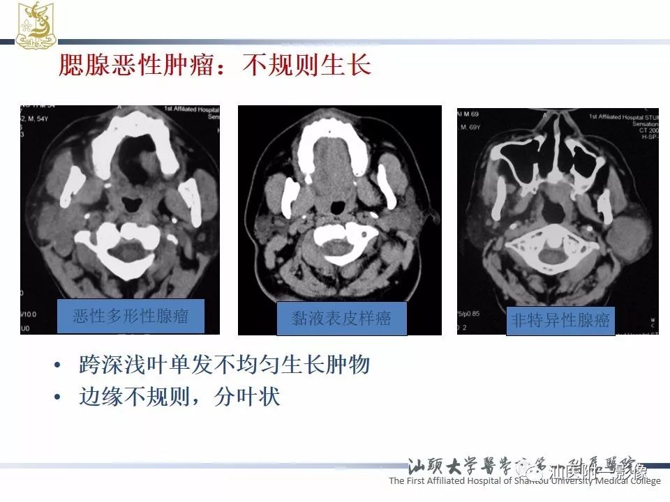 【PPT】腮腺病变CT诊断-17