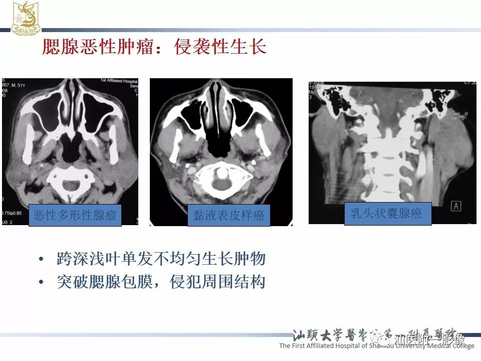 【PPT】腮腺病变CT诊断-18