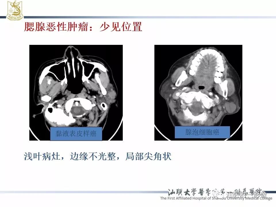 【PPT】腮腺病变CT诊断-19