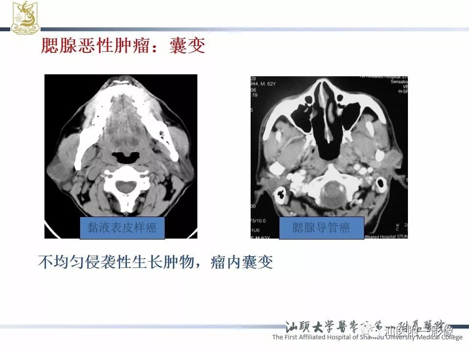 【PPT】腮腺病变CT诊断-20