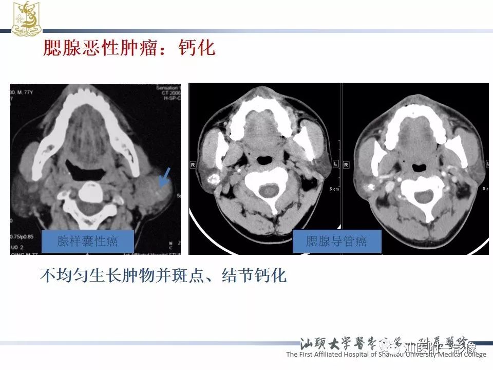 【PPT】腮腺病变CT诊断-21