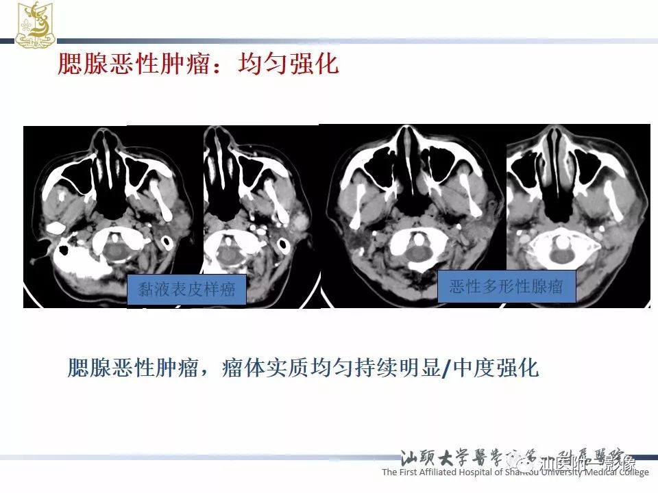 【PPT】腮腺病变CT诊断-22