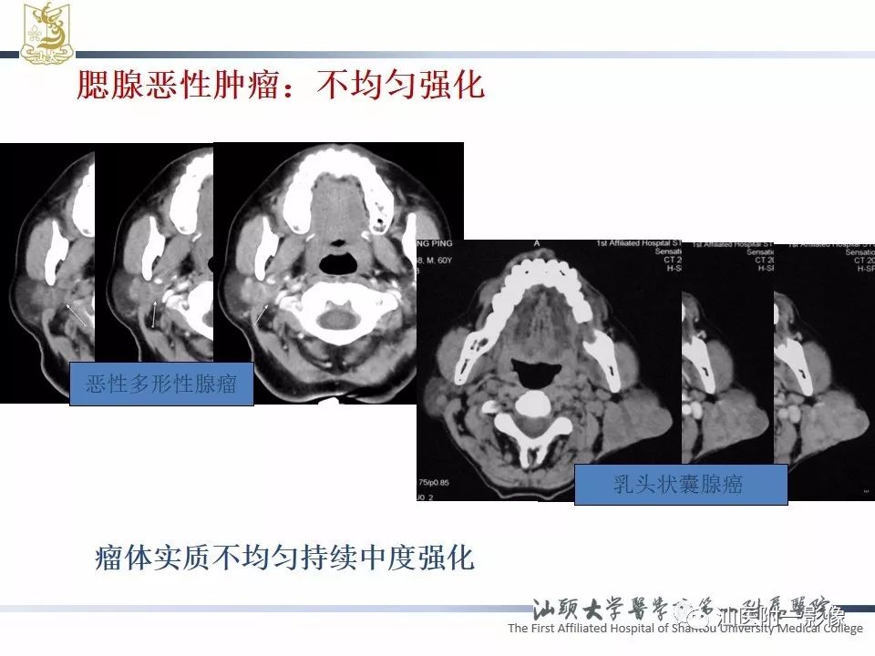 【PPT】腮腺病变CT诊断-23