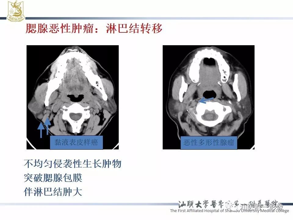 【PPT】腮腺病变CT诊断-24