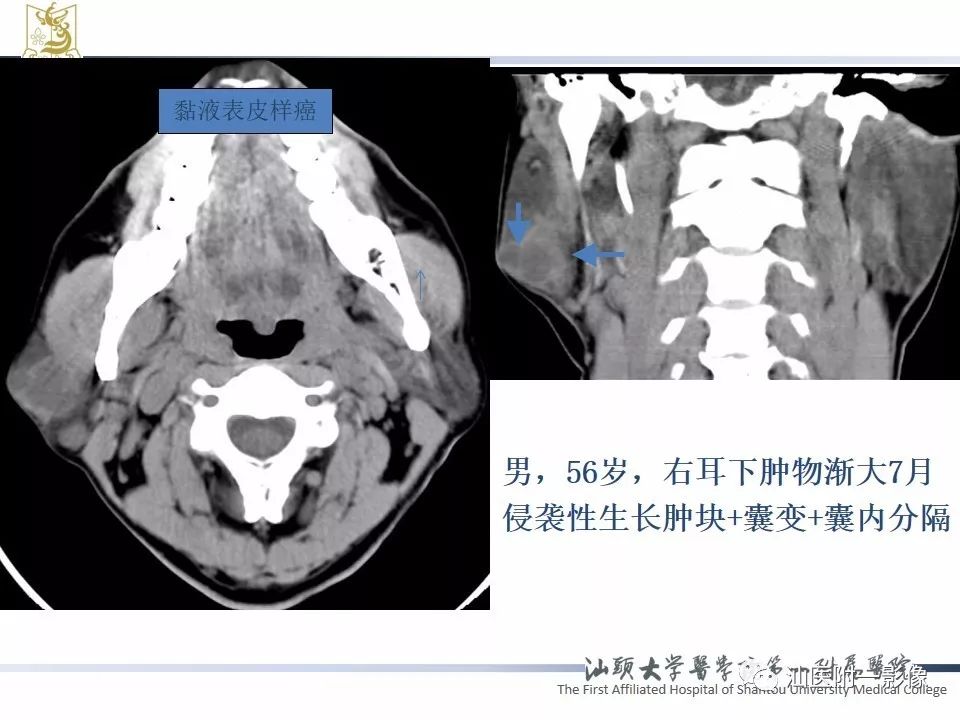 【PPT】腮腺病变CT诊断-27