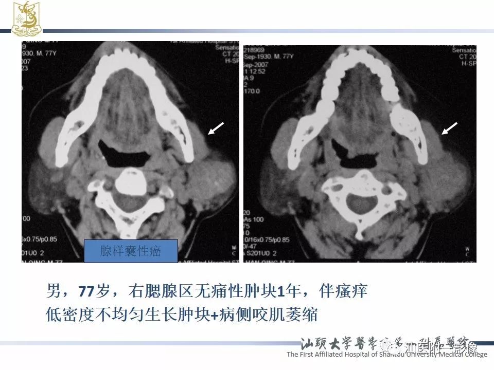 【PPT】腮腺病变CT诊断-28