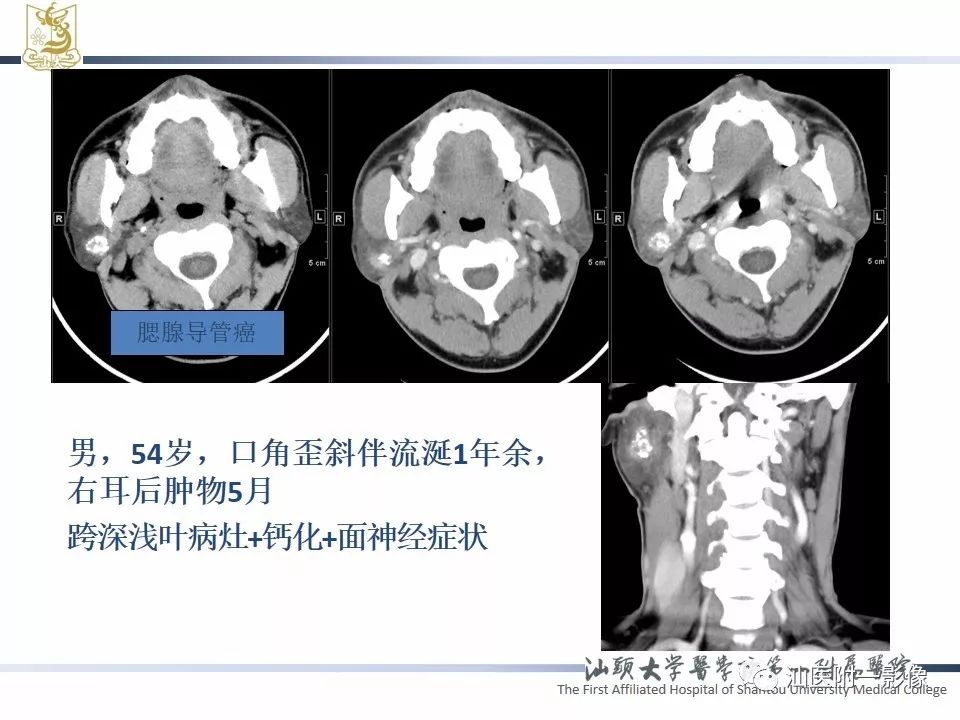 【PPT】腮腺病变CT诊断-29