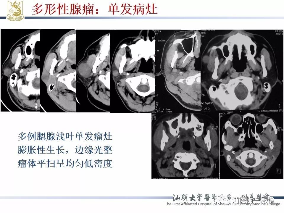 【PPT】腮腺病变CT诊断-36