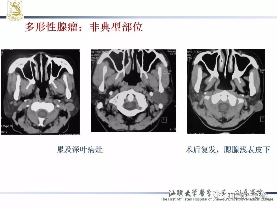 【PPT】腮腺病变CT诊断-37