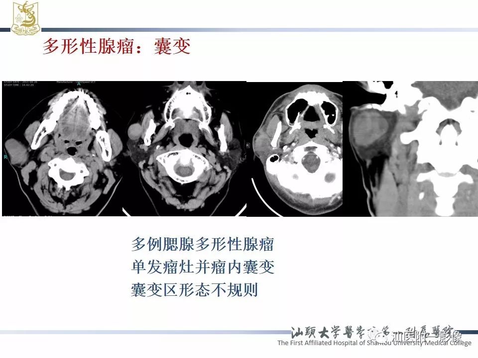 【PPT】腮腺病变CT诊断-38