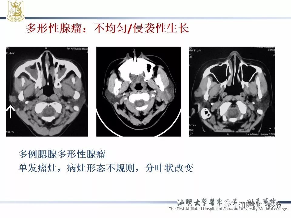 【PPT】腮腺病变CT诊断-40