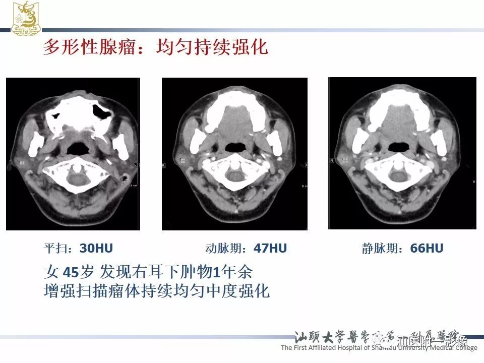 【PPT】腮腺病变CT诊断-41