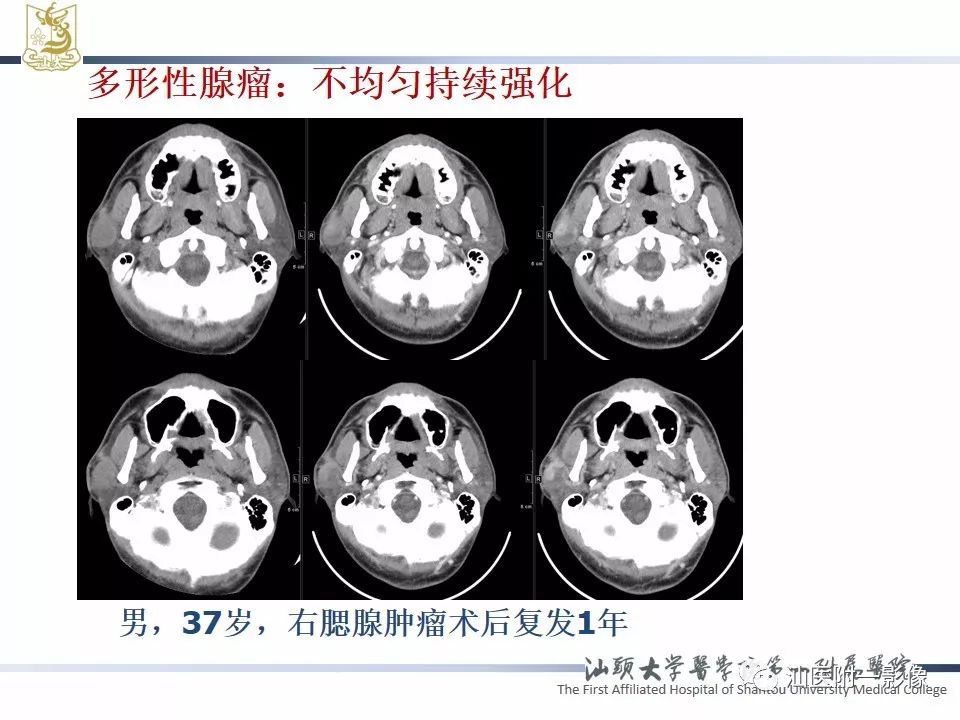 【PPT】腮腺病变CT诊断-42
