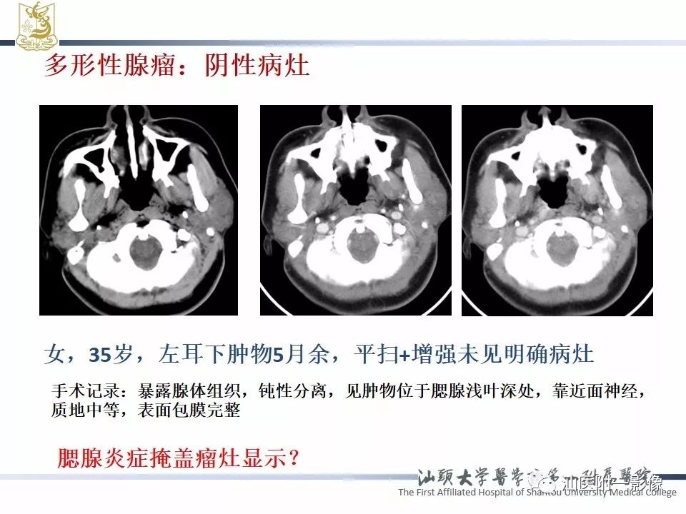 【PPT】腮腺病变CT诊断-43