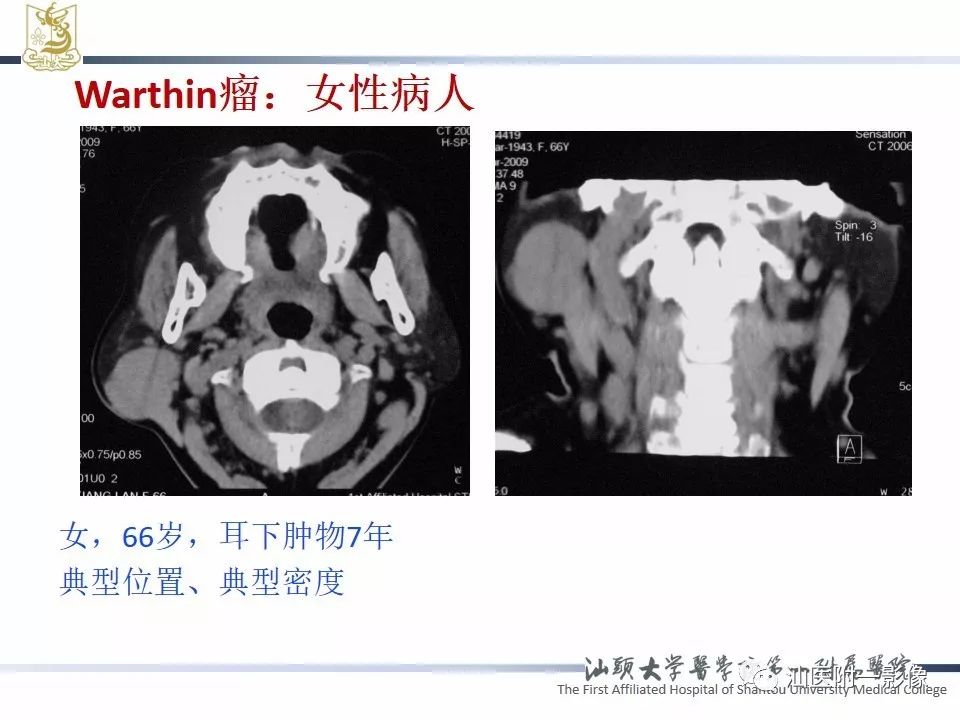 【PPT】腮腺病变CT诊断-46