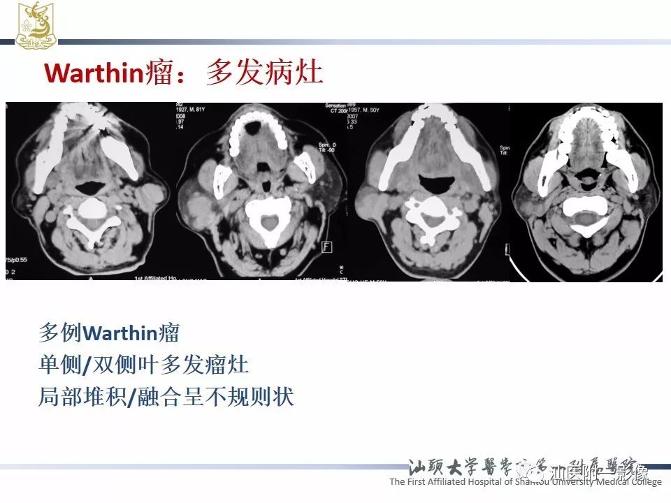 【PPT】腮腺病变CT诊断-47