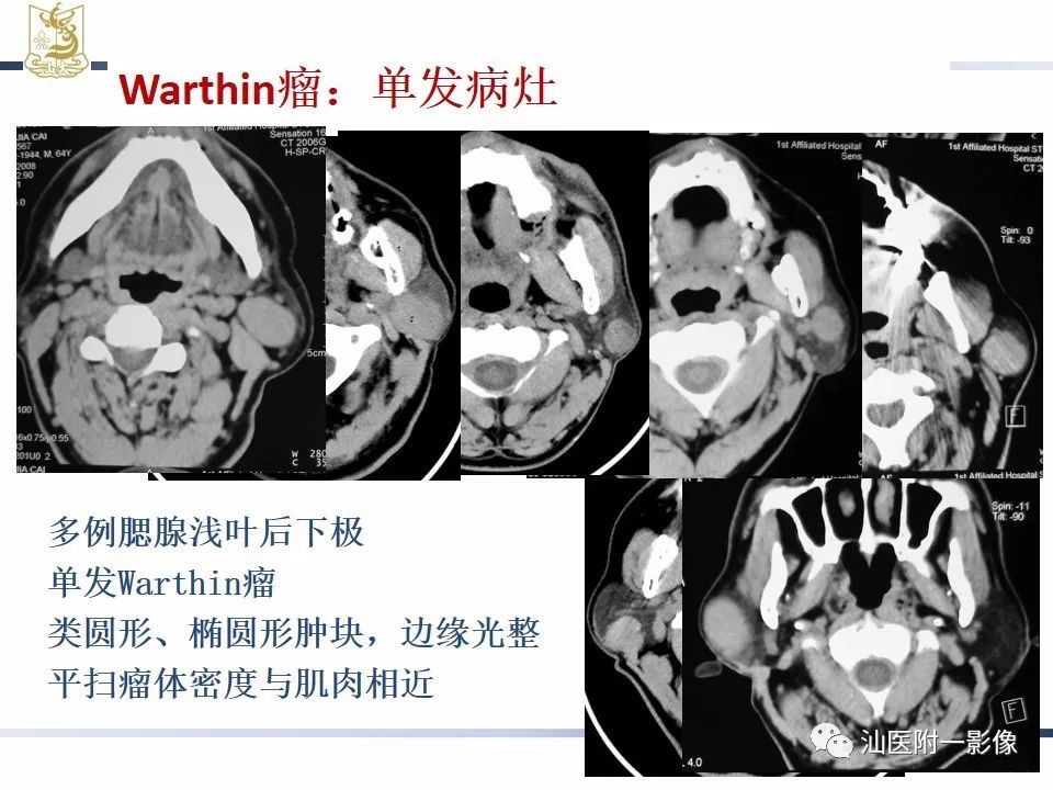 【PPT】腮腺病变CT诊断-48