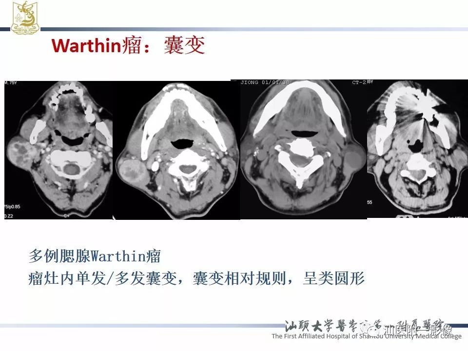 【PPT】腮腺病变CT诊断-50