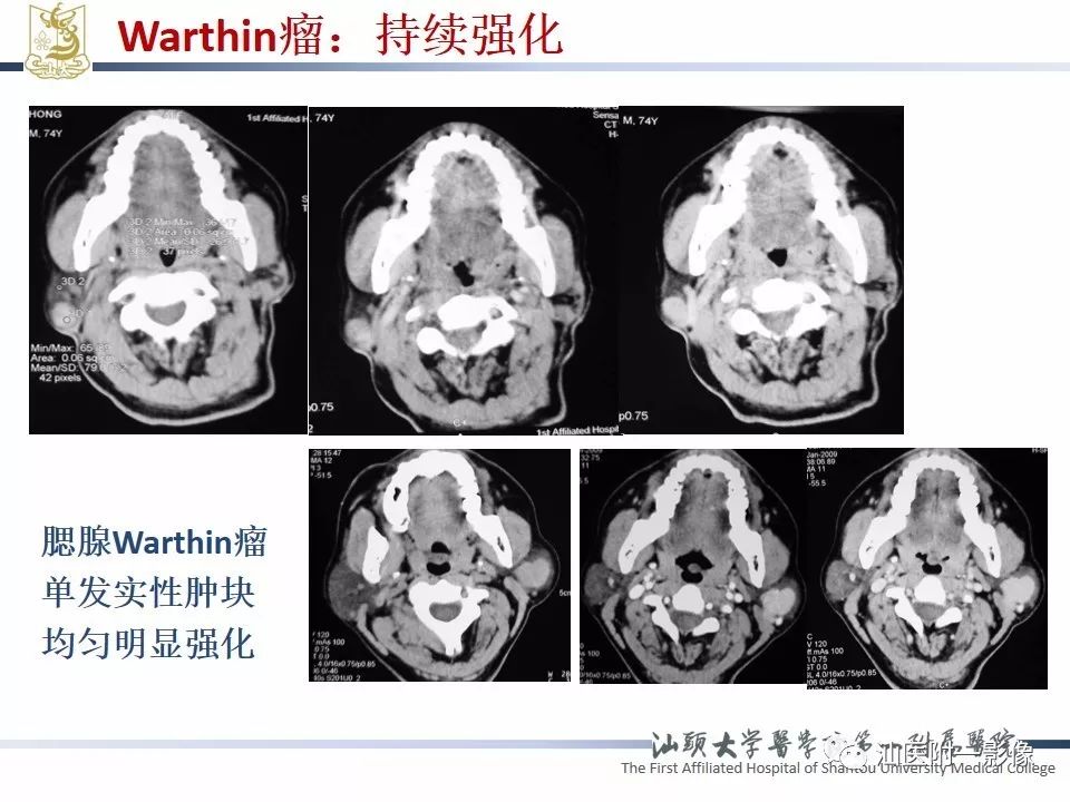 【PPT】腮腺病变CT诊断-51