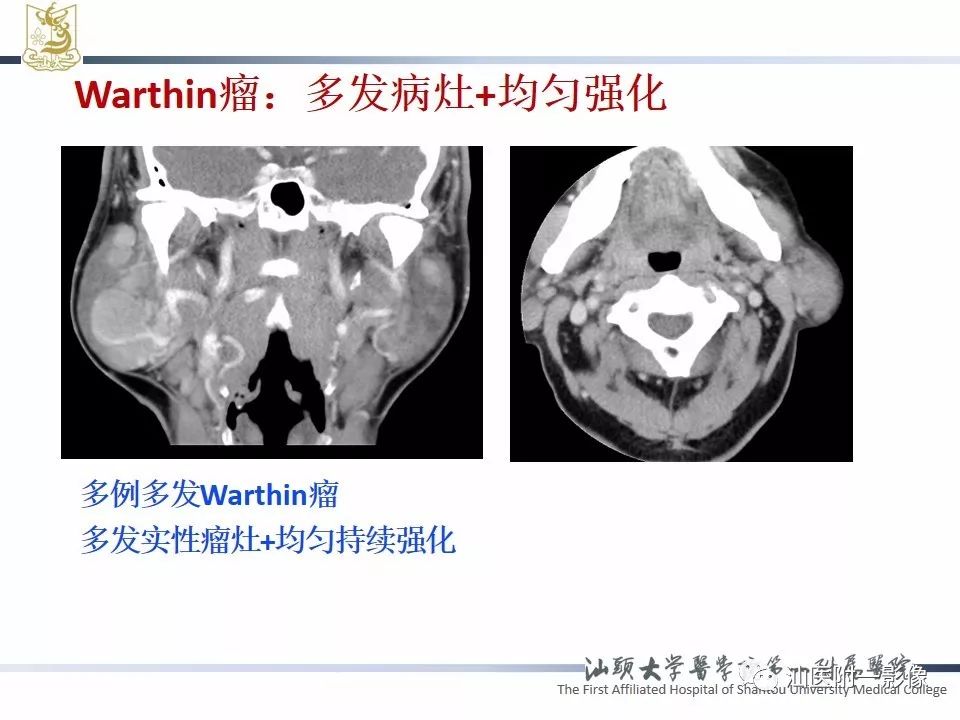 【PPT】腮腺病变CT诊断-52