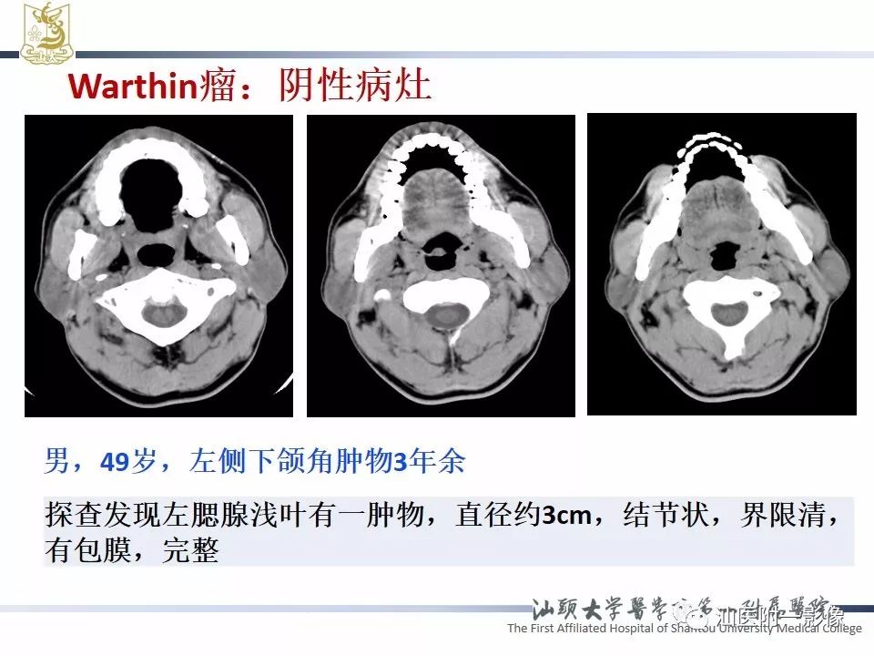 【PPT】腮腺病变CT诊断-53