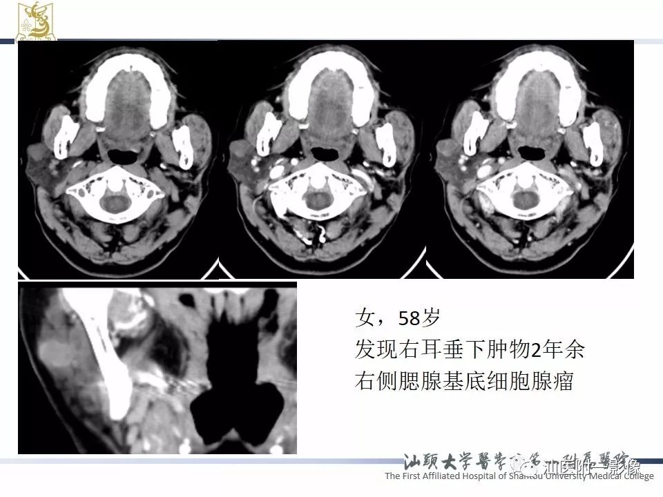【PPT】腮腺病变CT诊断-56