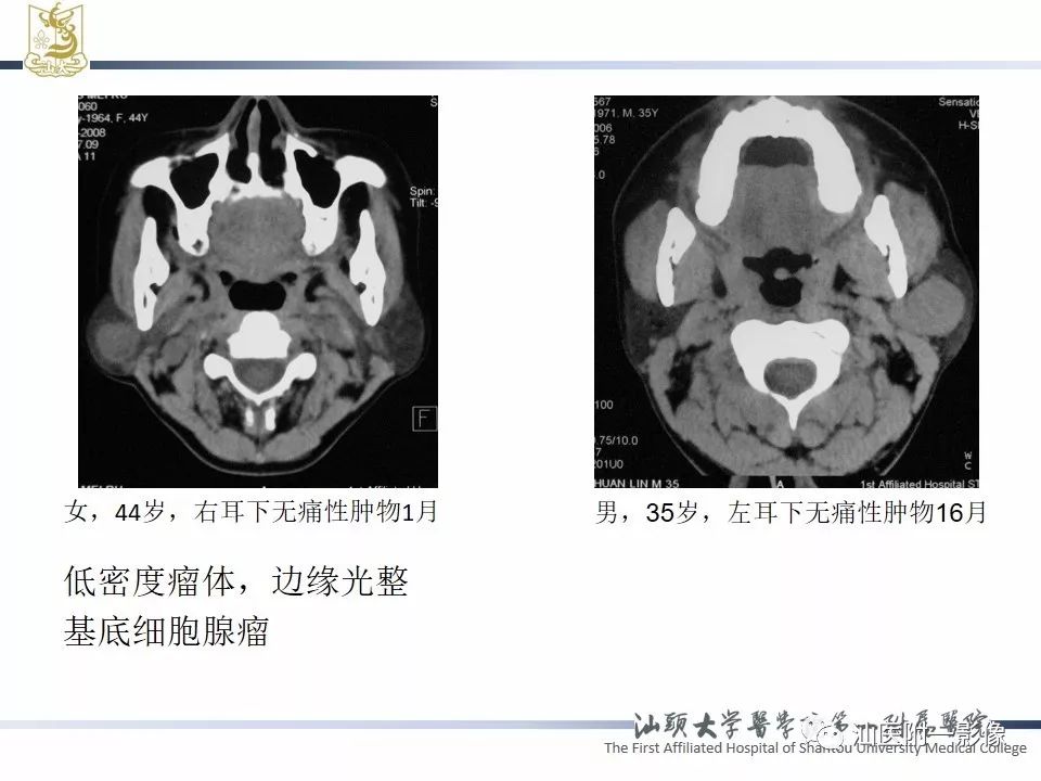 【PPT】腮腺病变CT诊断-58