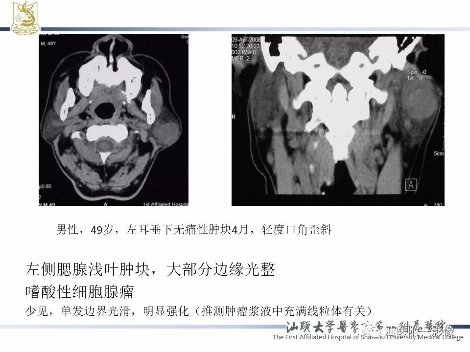 【PPT】腮腺病变CT诊断-59
