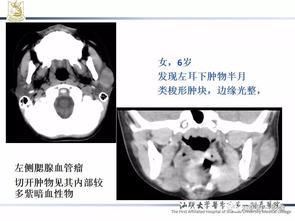 【PPT】腮腺病变CT诊断-62