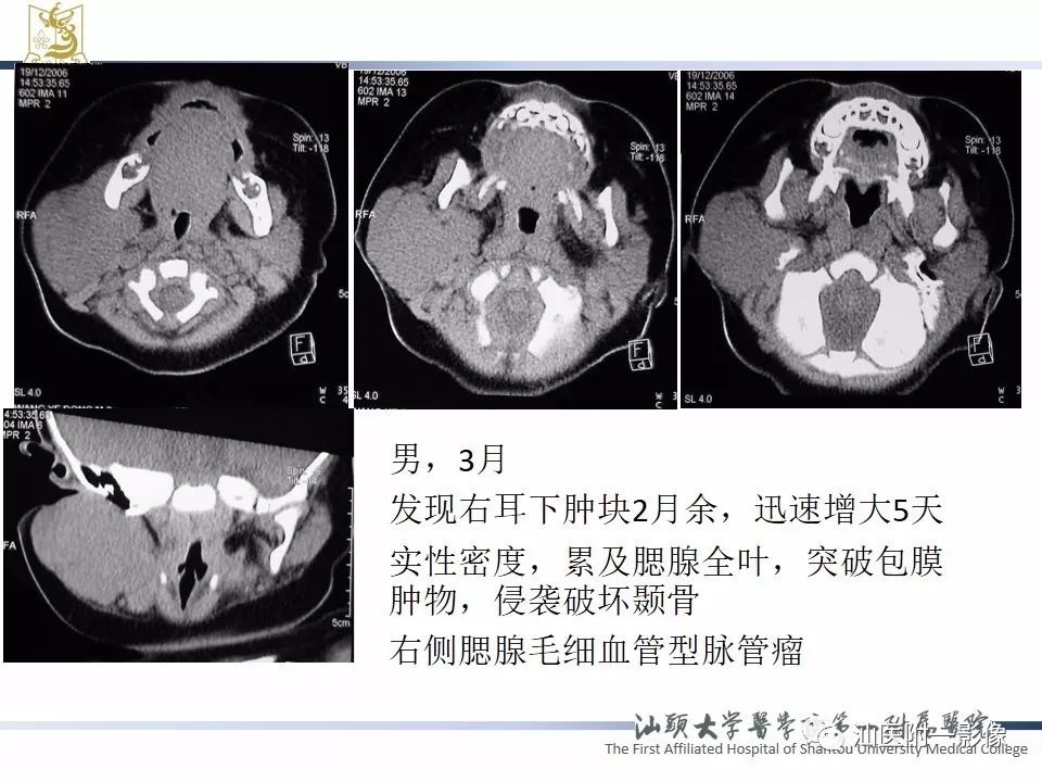 【PPT】腮腺病变CT诊断-63